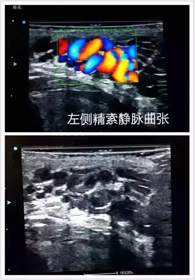 B超彩超有什么区别,妇科b超和阴超的区别