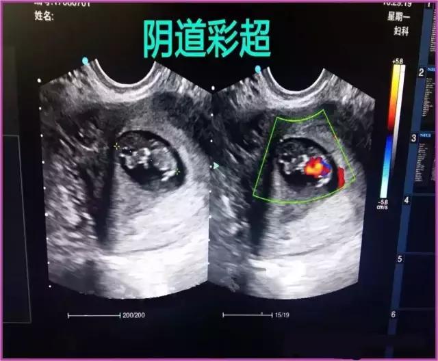 B超彩超有什么区别,妇科b超和阴超的区别