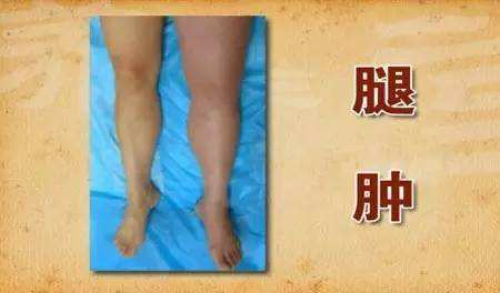 12个容易被忽略的心血管疾病诱因,常见致命心血管疾病