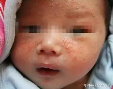 宝宝捂出来的湿疹如何下去,宝宝被湿疹折磨的睡不着觉视频