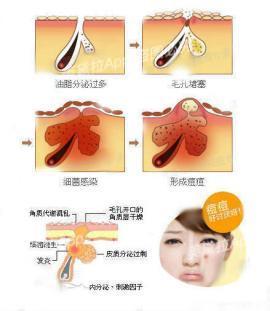 粉刺没有处理好变成硬疙瘩,痘痘粉刺消不掉