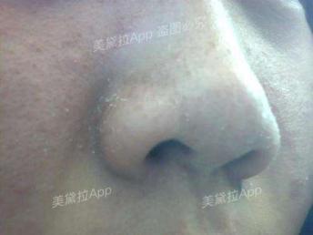 粉刺没有处理好变成硬疙瘩,痘痘粉刺消不掉