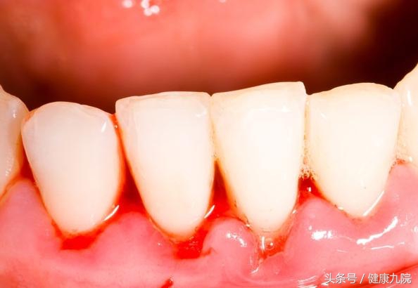 口腔出血警惕四种疾病,口腔出血警惕四种病