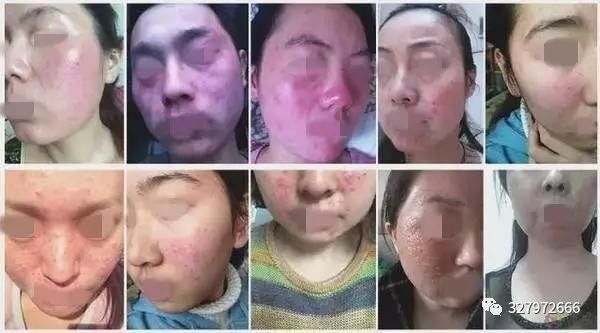 朵嘉浓修复激素脸案例,朵嘉浓修护激素脸