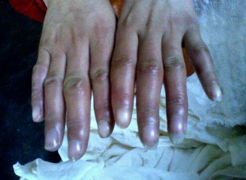 脸部冻伤用什么冻疮膏管用,冻伤可以用冻疮药膏吗