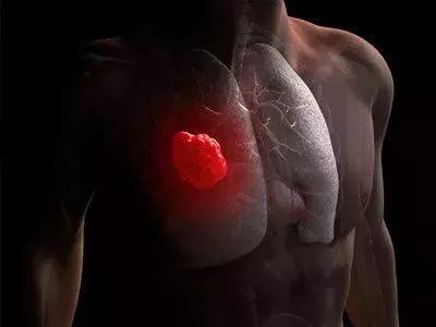 香港最新治疗肺癌的药物,治疗小细胞肺癌的印度进口药