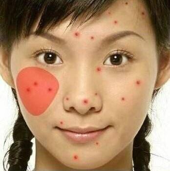 长痘真的影响颜值教你祛痘小妙招,祛痘小知识如何正确避免长痘