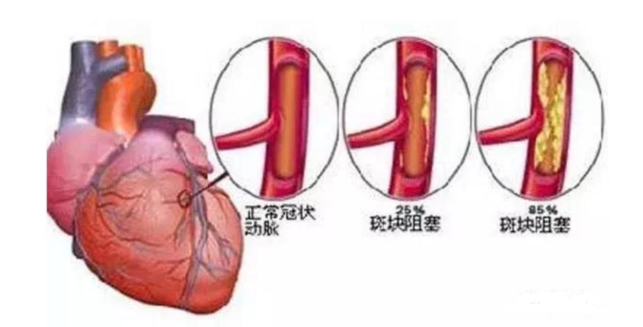 太极拳站桩治疗脑梗塞吗,站桩对心脑血管病有帮助吗
