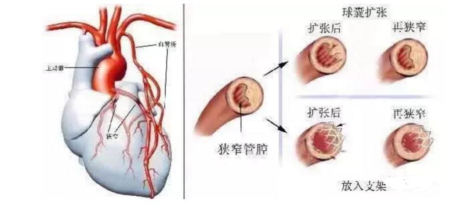 中医治疗心脑血管站桩,练太极站桩对心脑血管有帮助吗