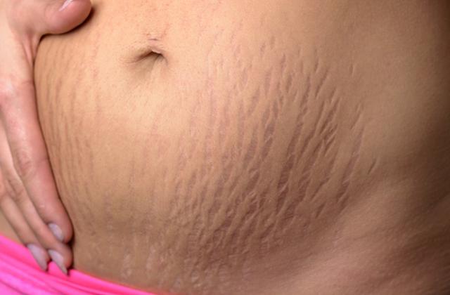 怀孕后如何消除妊娠纹:12个有效方法任你选