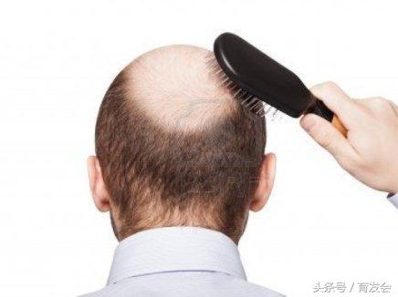 硫磺膏洗头发对脂溢性脱发的帮助,脂溢性脱发可以用二硫化硒洗头吗