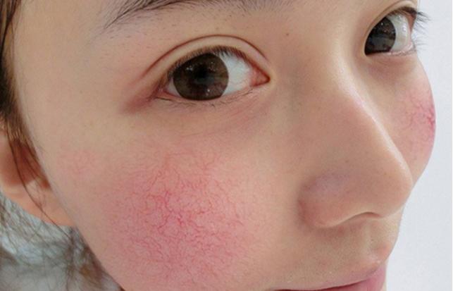 皮肤粘胶带过敏用什么方法不过敏,皮肤红痒过敏好了过几天后过敏