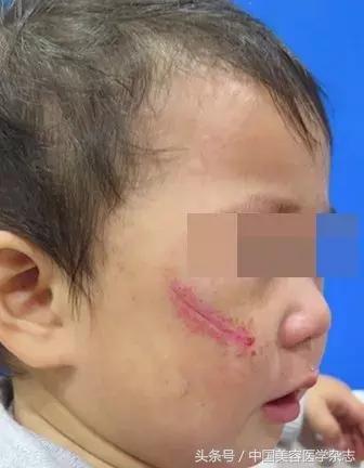 点阵激光治疗下颌瘢痕疙瘩有效么,二氧化碳激光治疗瘢痕增生原理