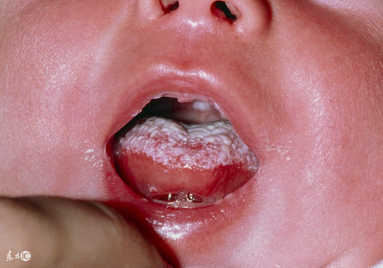 鹅口疮引起败血症,鹅口疮会诱发败血症吗