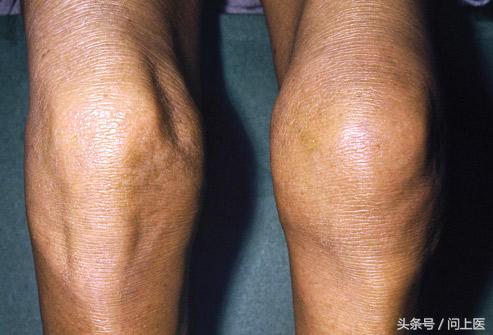 高中生膝盖疼痛的原因和解决方法,膝盖内侧靠下位置疼痛是什么原因