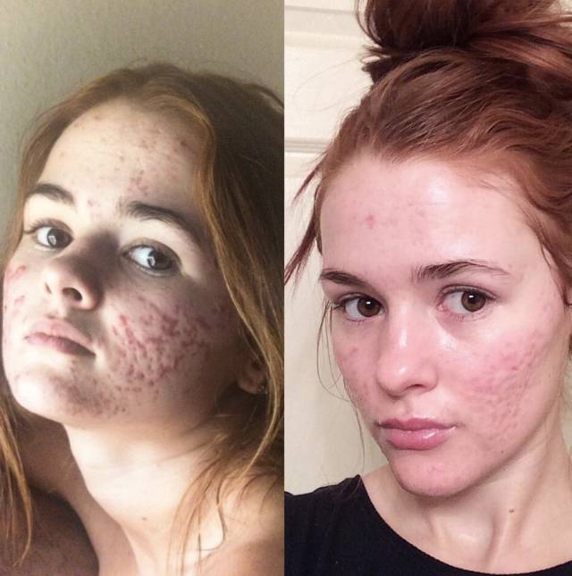 360°真实记录从满脸痘到痊愈，她红遍了Ins