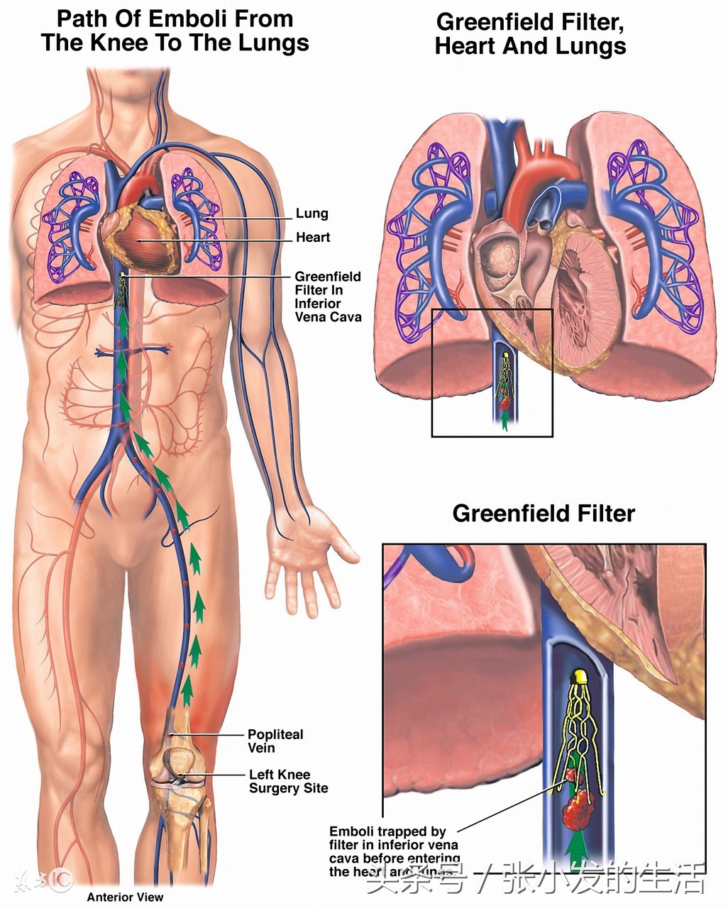 急性肺栓塞的表现怎么处理,肺栓塞紧急处理科普视频