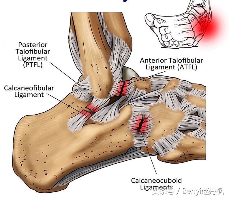 脚踝受伤半年后如何康复训练,脚踝伤病的六个问题