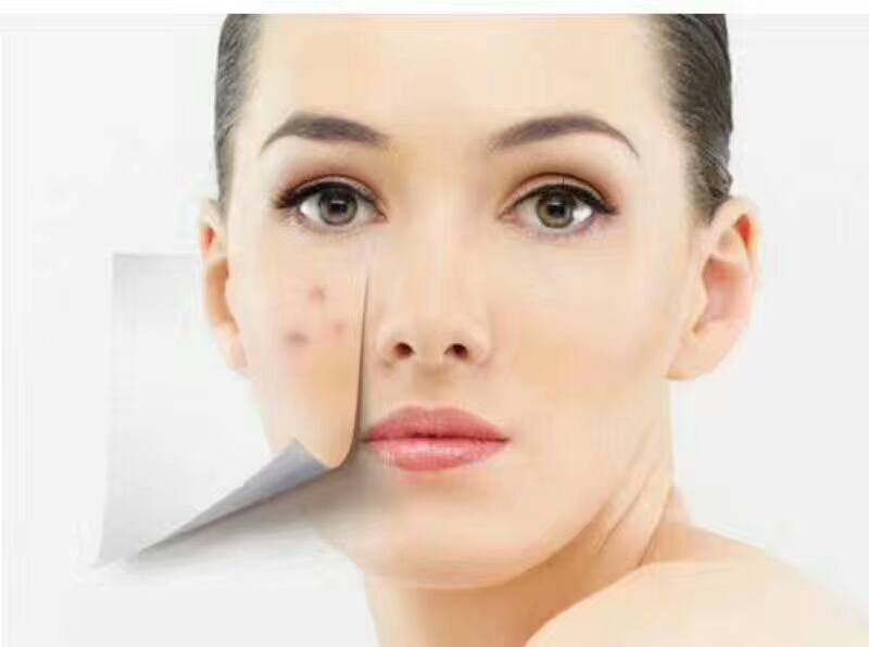 医生推荐淡化痘印,按摩痘印能淡化吗