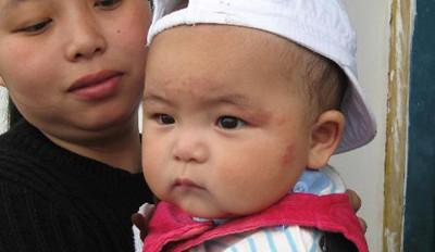 宝宝得了湿疹怎么解决,宝宝得湿疹严重怎么办