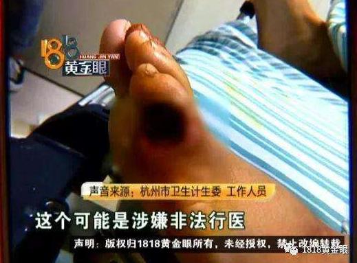 脚上长奇奇怪怪的东西是什么,脚上长像面包糠样的东西