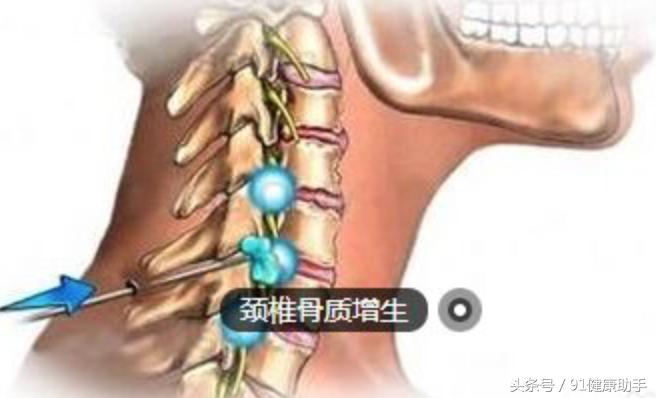 颈椎四至七节增生怎么治疗,脊椎增生怎么治疗最好