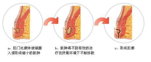 我怎么得了肛瘘？该如何预防与治疗？