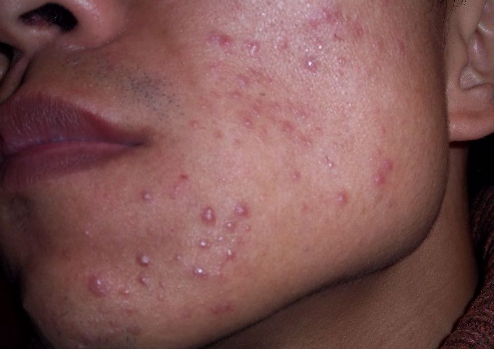 痘痘在同一个位置反复长因为什么,痘痘同个地方反复长怎么解决