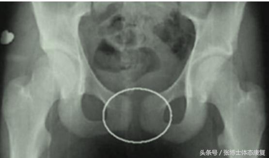 耻骨联合痛康复动作,耻骨分离产后走路超级疼怎么缓解