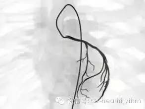 哪些人需要做冠脉造影动画,什么人需做心脏冠脉造影