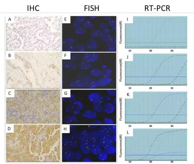 ros1克唑替尼,ros1克唑替尼耐药后可以吃什么