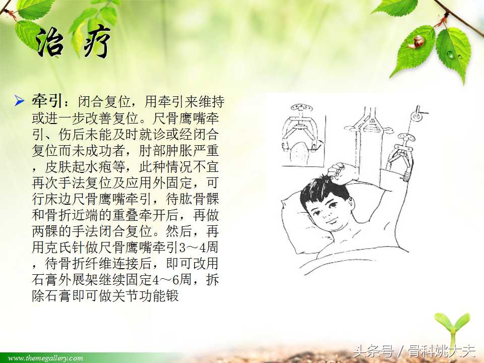 儿童肱骨干骨折处理方法,小孩胳膊肱骨骨折恢复最佳的方法