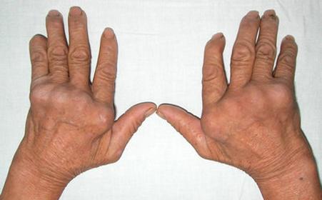 健康之路始于脚下,痛风健康之路