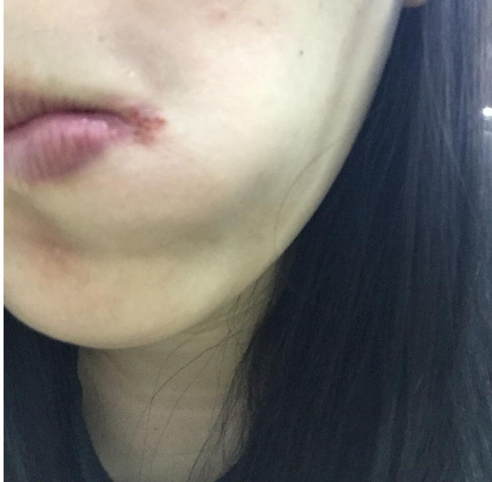 烂嘴角吃什么降火,冬天上火嘴巴烂了吃什么