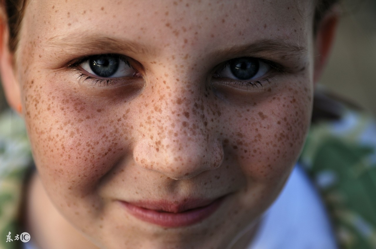 男性遗传雀斑如何避免遗传下一代,爸爸雀斑会遗传给女儿吗如何避免