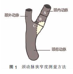 颈动脉狭窄80%的症状和表现,颈动脉狭窄中医最好的治疗方法