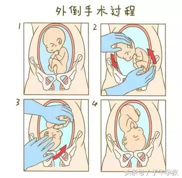 生孩子胎位不正推肚子矫正胎位,纠正胎位的姿势有哪些