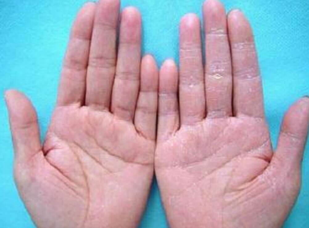患有手足皲裂（裂口子）症的亲，最值得收藏哟