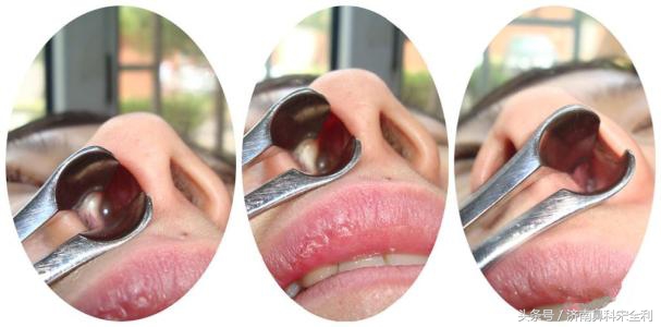 鼻息肉术后为什么会复发,鼻息肉手术后又复发了怎么处理