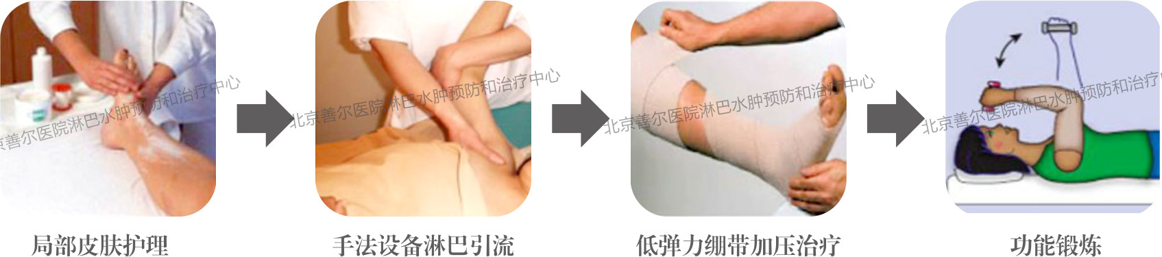 乳腺癌术后上肢水肿最新治疗方法,乳腺癌淋巴水肿案例分析