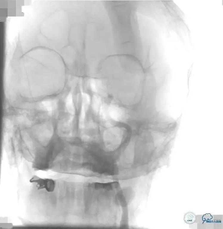 急性缺血性卒中静脉溶栓2018指南,急性缺血性卒中血管内再通标准