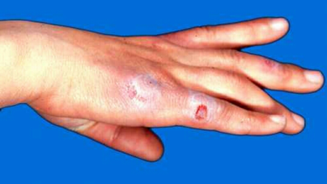 冻伤疮最佳治疗方案,冻伤疮什么意思