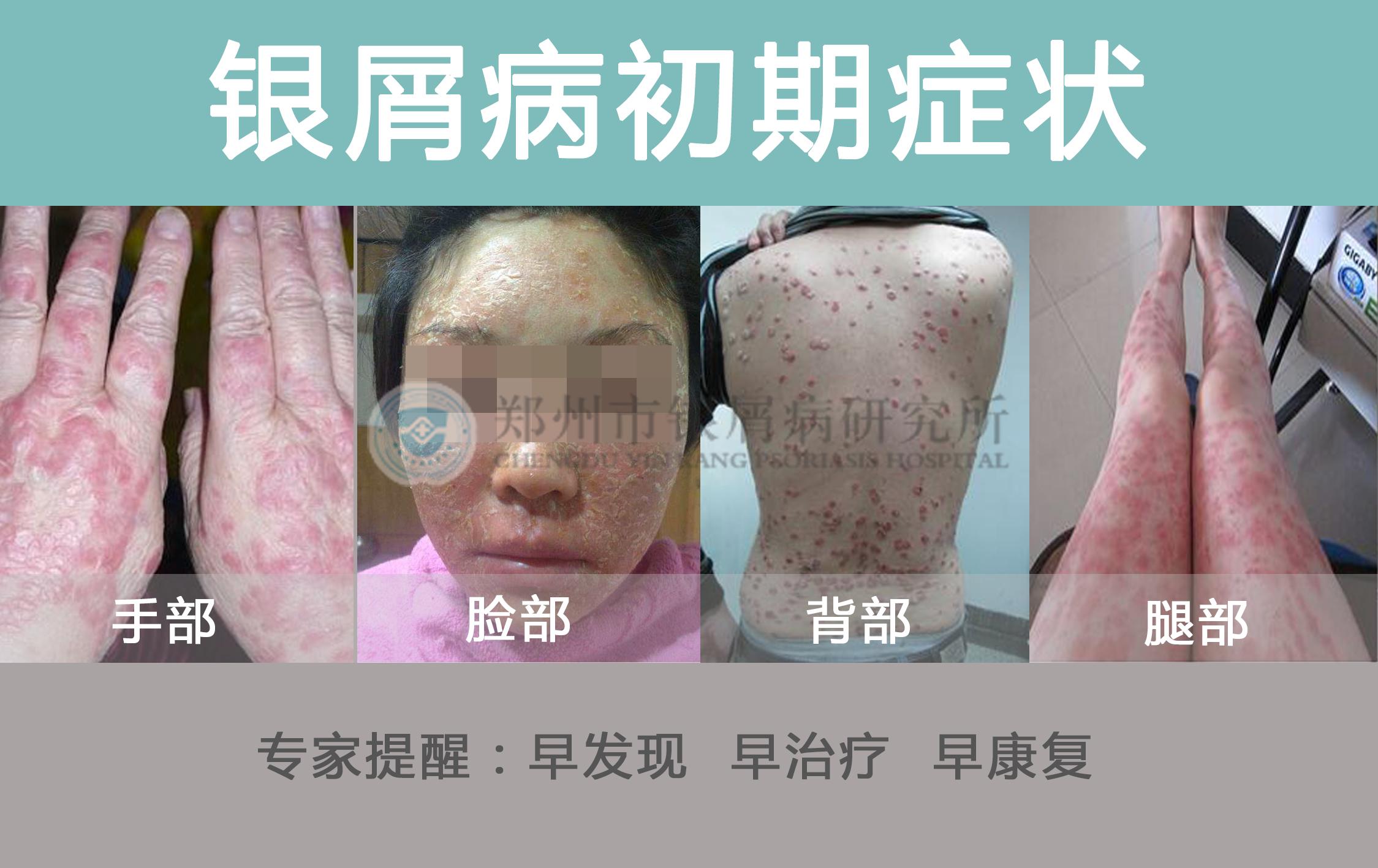 皮癣区分,皮癣和牛皮癣的区别