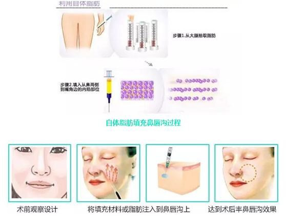 怎么去除法令纹最有效的方法医美,去皱纹最好的方法去法令纹