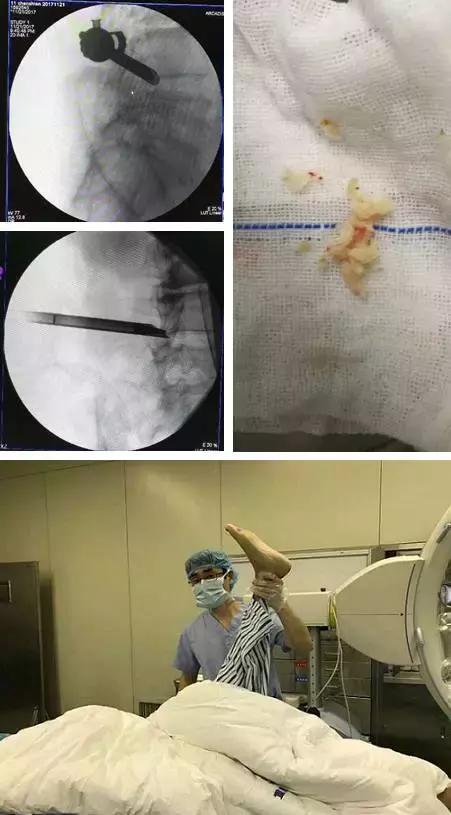 脊柱内镜辅助治疗脱垂游离型腰椎间盘突出1例