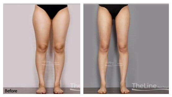 腿粗根本原因就是两腿之间赘肉太多，下半身臃肿，身高明显低一截