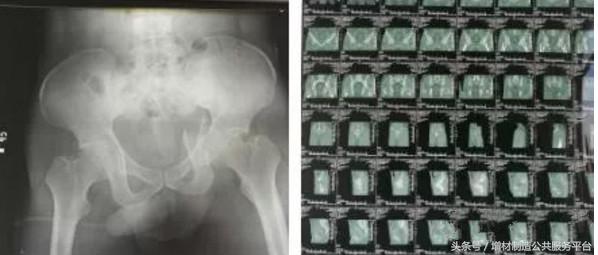 3d打印骨盆骨折成功案例,骨盆骨折抢救视频