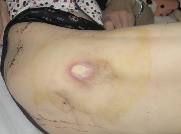 骨结核手术治疗后多长时间能痊愈,骨结核手术治疗费用