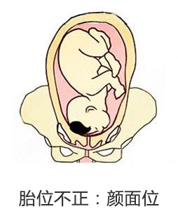 产妇胎位不正医生纠正难产完整版,孕妇胎位不正什么原因导致的