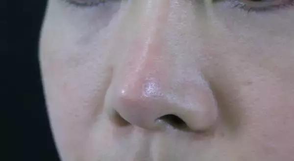 假体隆鼻都有什么术式,假体隆鼻一般用什么材料